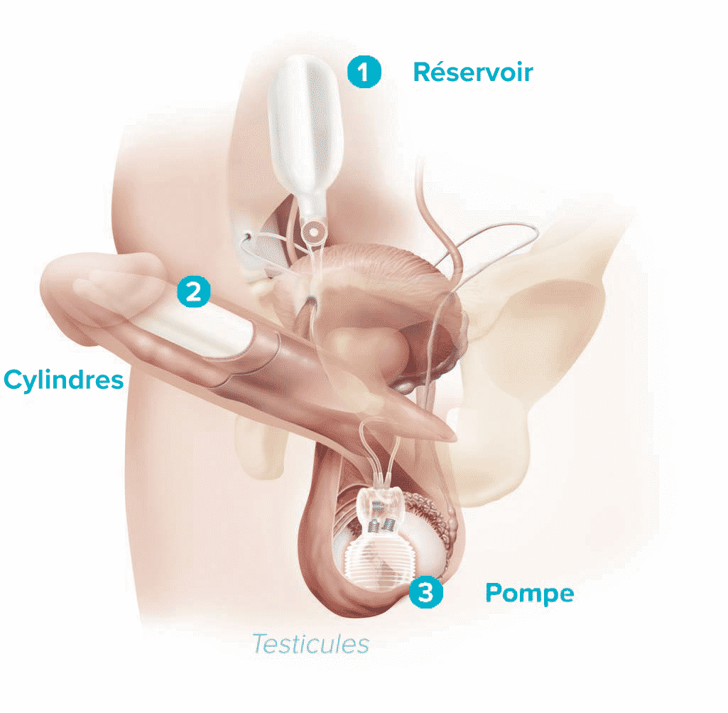 implant pénien gonflable schéma